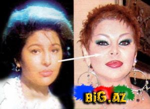 Şou-biznesimizin plastik əməliyyat keçirən simaları